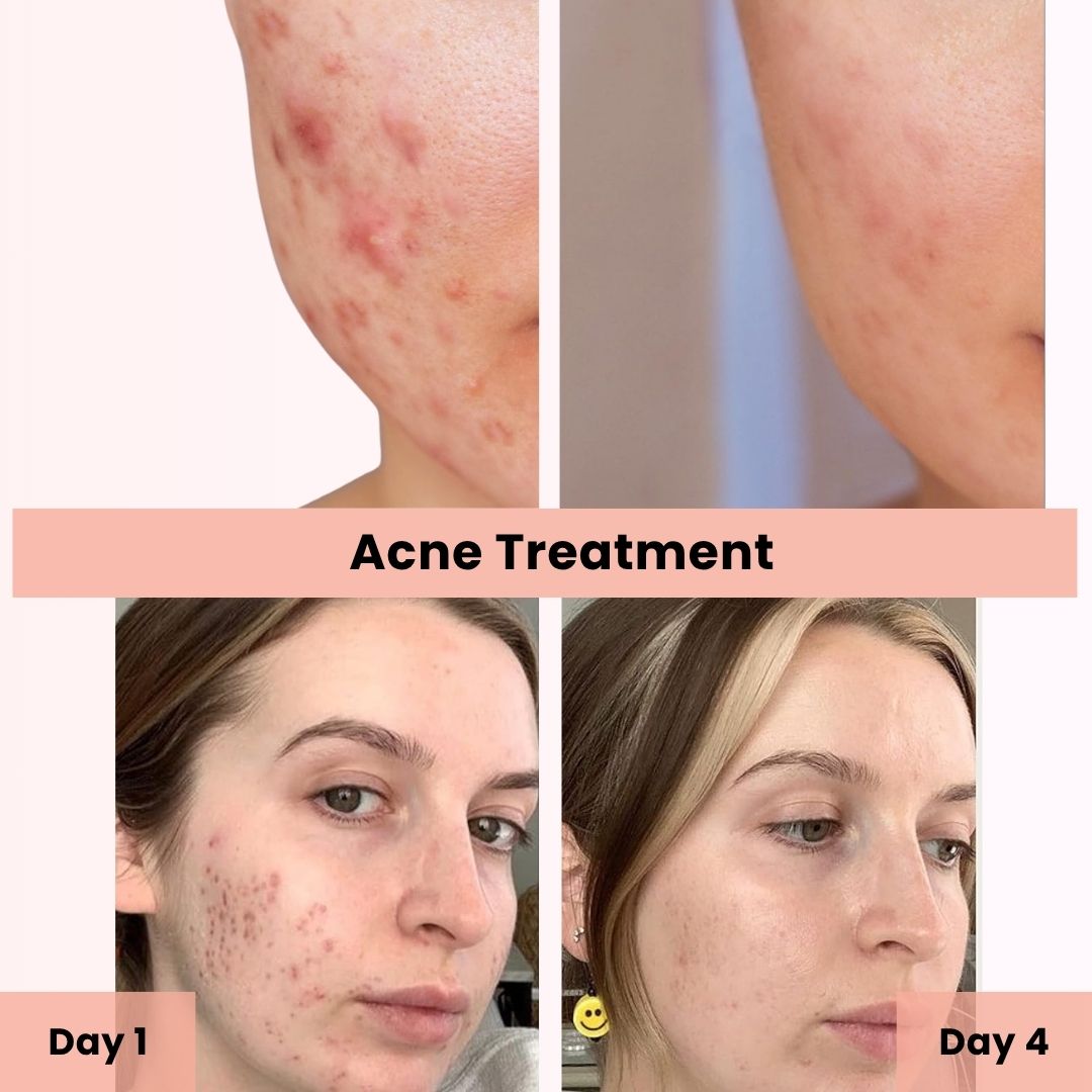 AcneOny™ – High Frequency Wand