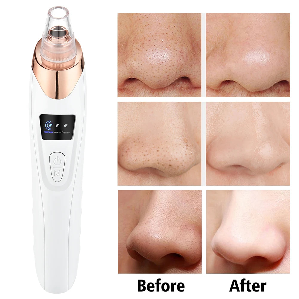 Blackhead Remover